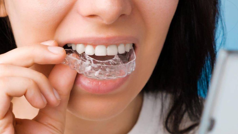 Invisalign Aberdeen