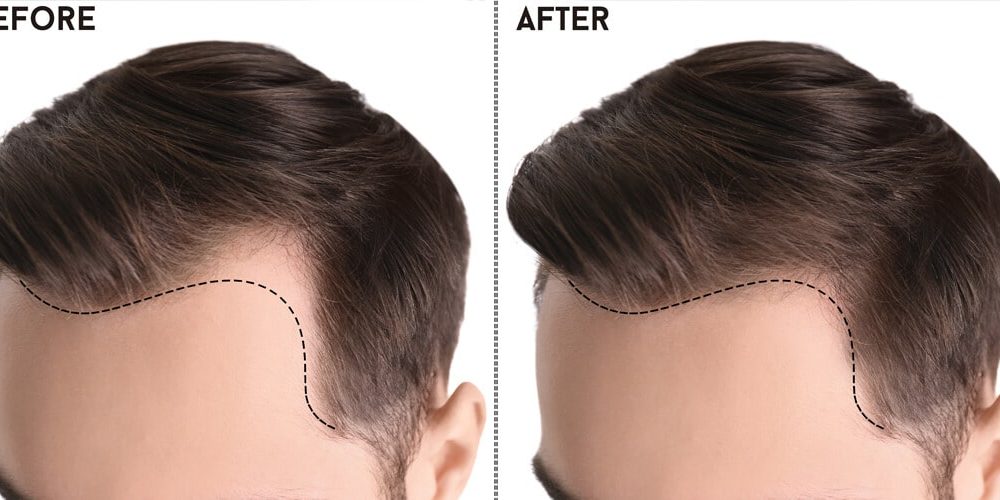 Best Hair Transplant in Pakistan