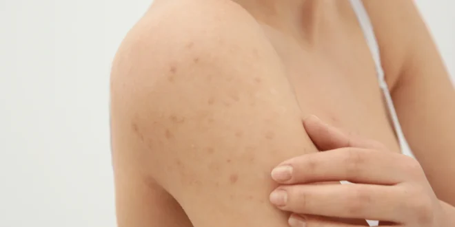 How to Identify, Treat, and Prevent Scabies