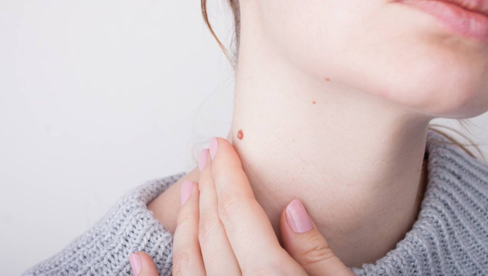 Remove skin tags Sydney